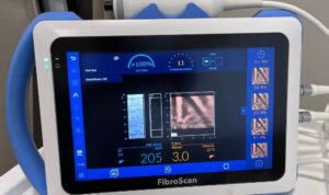 Fibroscan LycaHealth Orpington
