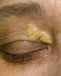 Xanthelasma (yellowish patches on the eyelids)