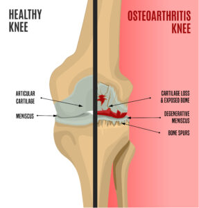 Osteoarthritis is one of the most common causes of knee pain. It occurs when the protective cartilage within the joint gradually wears down over time, leading to pain, stiffness, swelling, and reduced mobility.